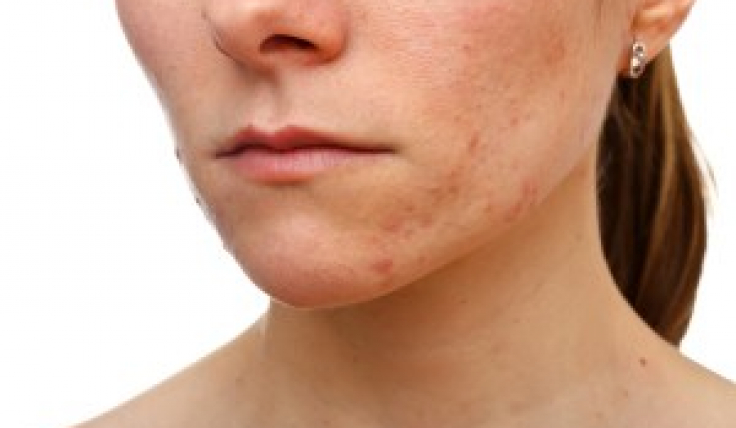 Acne 101 - Children's Physicians Medical Group