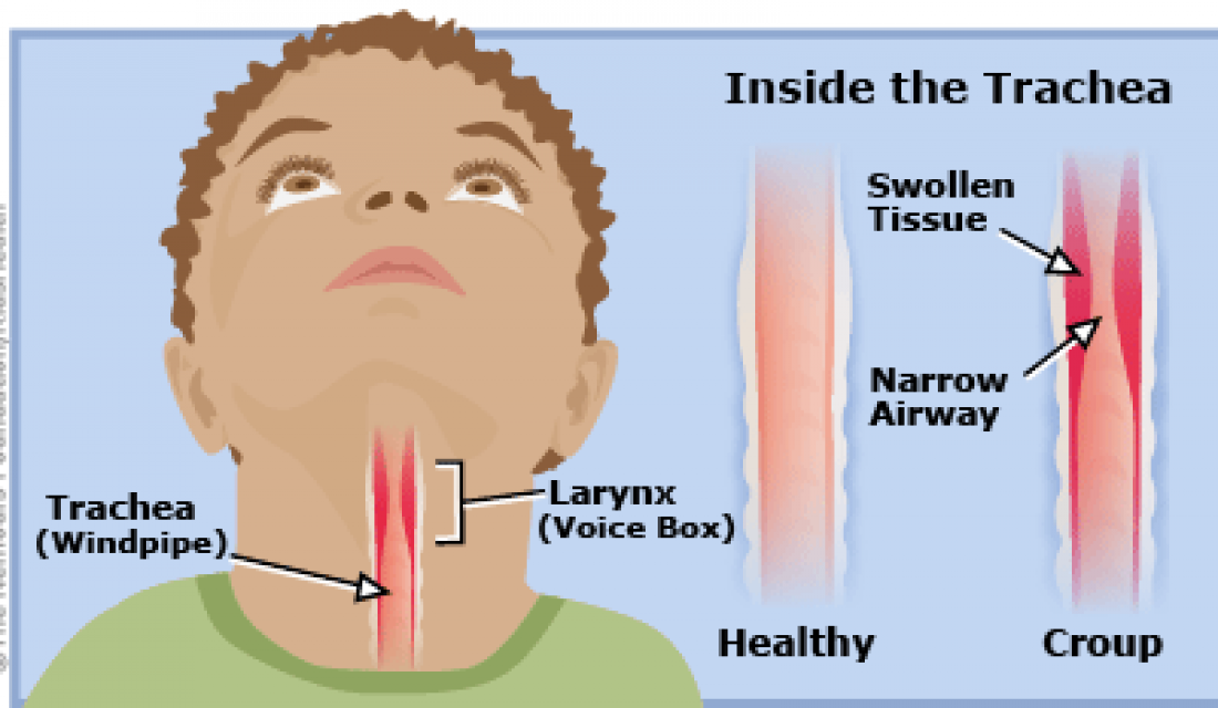 Croup Childrens Physicians Medical Group